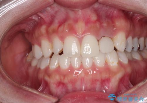 外れそうで不適合のかぶせ物の根管治療からの再治療の症例 治療前