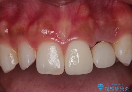 外れそうで不適合のかぶせ物の根管治療からの再治療の治療前