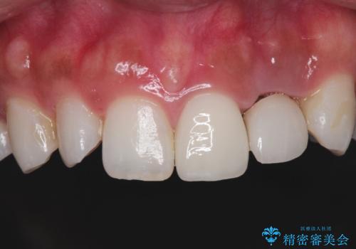 外れそうで不適合のかぶせ物の根管治療からの再治療