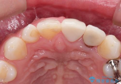 外れそうで不適合のかぶせ物の根管治療からの再治療の治療前