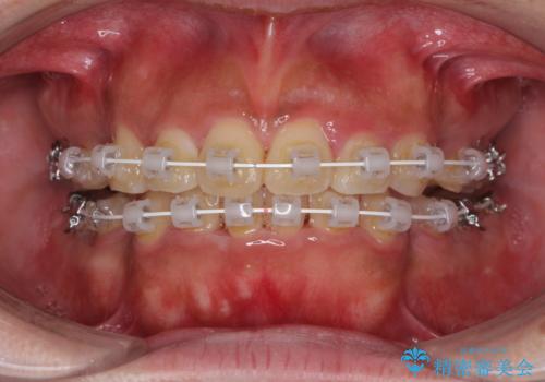口元の突出感を改善　ワイヤー装置による抜歯矯正の治療中