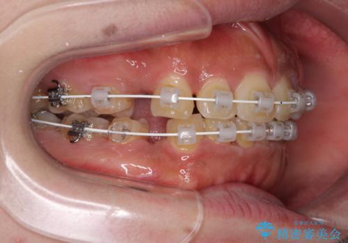 口元の突出感を改善　ワイヤー装置による抜歯矯正の治療中