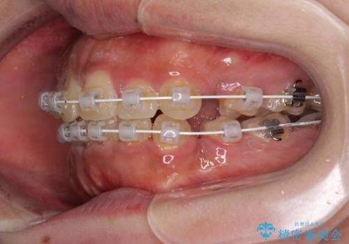 口元の突出感を改善 ワイヤー装置による抜歯矯正の治療中