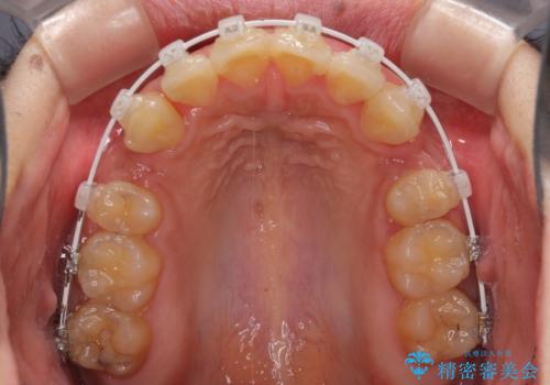 口元の突出感を改善 ワイヤー装置による抜歯矯正の治療中