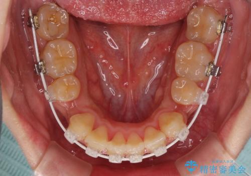 口元の突出感を改善 ワイヤー装置による抜歯矯正の治療中