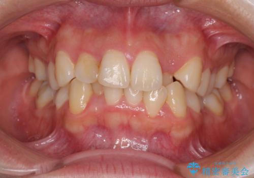 短期間で終了 デコボコをワイヤー矯正で解消の症例 治療前