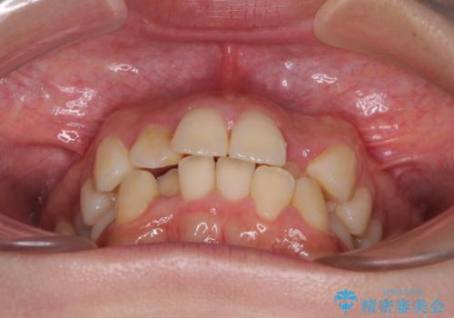 短期間で終了 デコボコをワイヤー矯正で解消の治療前