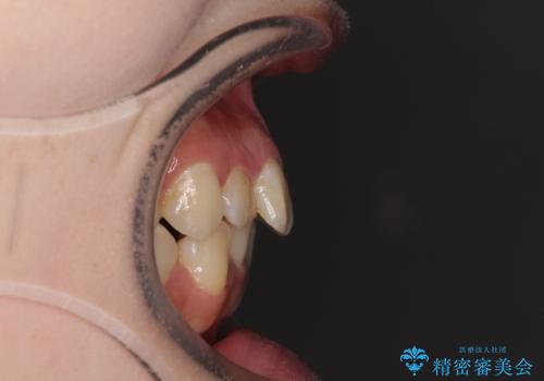 短期間で終了 デコボコをワイヤー矯正で解消の治療前