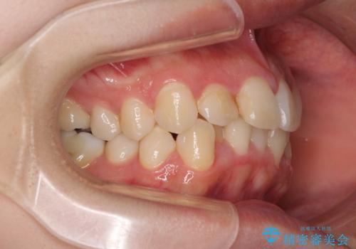 短期間で終了 デコボコをワイヤー矯正で解消の治療前