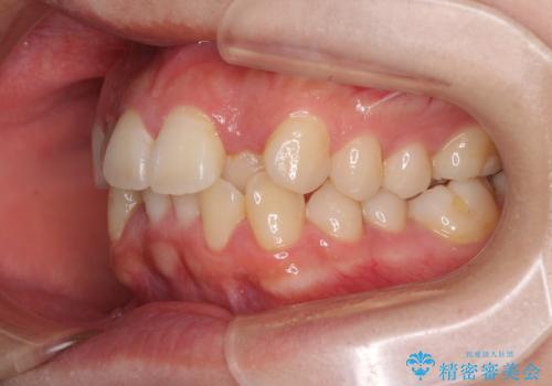 短期間で終了 デコボコをワイヤー矯正で解消の治療前