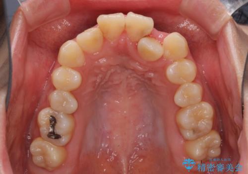 短期間で終了 デコボコをワイヤー矯正で解消の治療前