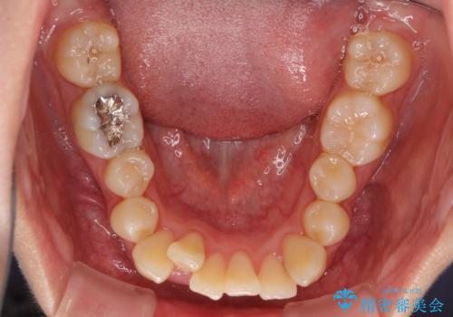 短期間で終了 デコボコをワイヤー矯正で解消の治療前
