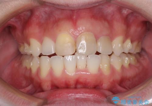 抜歯矯正の後戻り インビザラインによるオープンバイトの再矯正の治療中