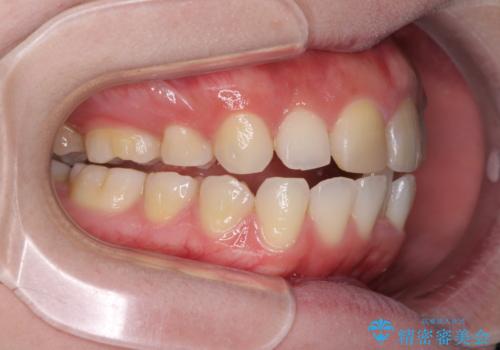 抜歯矯正の後戻り インビザラインによるオープンバイトの再矯正の治療中