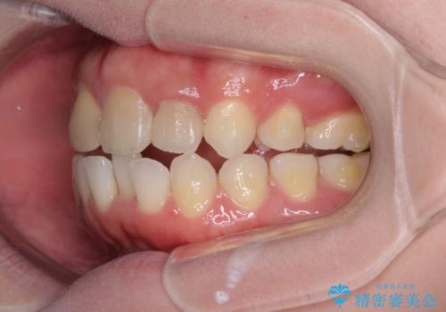 抜歯矯正の後戻り インビザラインによるオープンバイトの再矯正の治療中