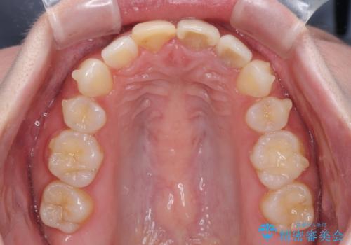 抜歯矯正の後戻り インビザラインによるオープンバイトの再矯正の治療中
