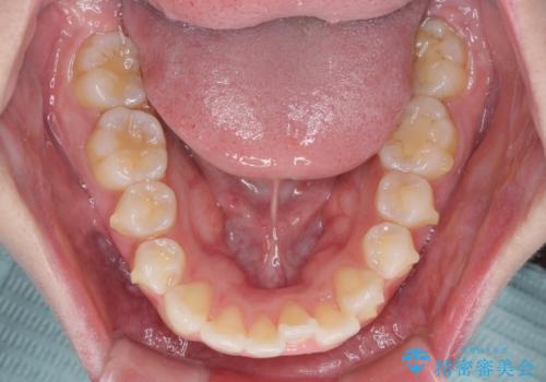 抜歯矯正の後戻り インビザラインによるオープンバイトの再矯正の治療中