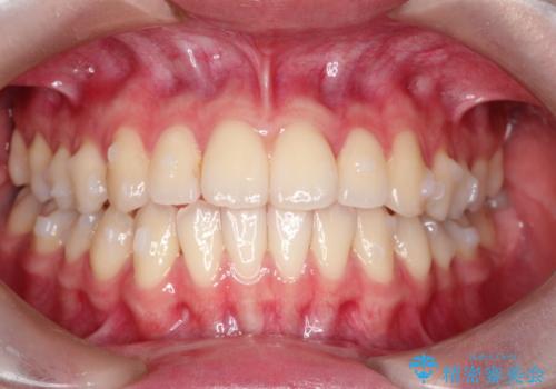 インビザラインによる非抜歯矯正 ガタガタな歯並びを整った歯並びへの治療中