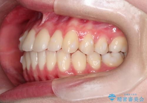 インビザラインによる非抜歯矯正 ガタガタな歯並びを整った歯並びへの治療中