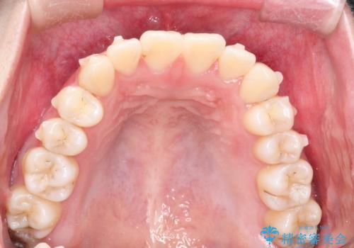 インビザラインによる非抜歯矯正 ガタガタな歯並びを整った歯並びへの治療中