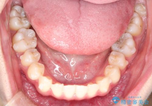 インビザラインによる非抜歯矯正 ガタガタな歯並びを整った歯並びへの治療中
