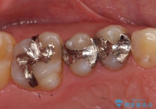 セラミック治療　銀歯を白い歯への症例 治療前