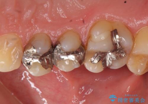 セラミック治療　銀歯を白い歯への治療前