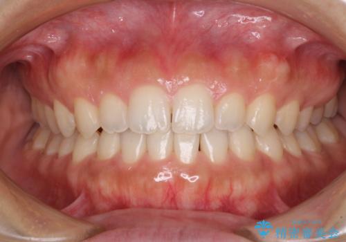 気になる隙間の再矯正 前歯をインビザライン・ライトで改善の治療中