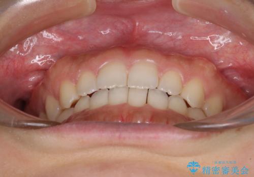気になる隙間の再矯正　前歯をインビザライン・ライトで改善の治療中