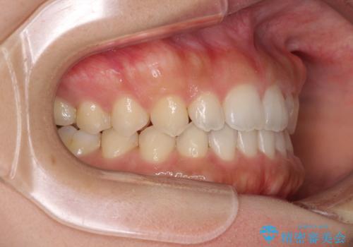 気になる隙間の再矯正　前歯をインビザライン・ライトで改善の治療中