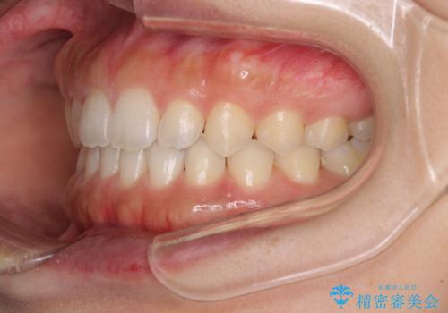 気になる隙間の再矯正 前歯をインビザライン・ライトで改善の治療中