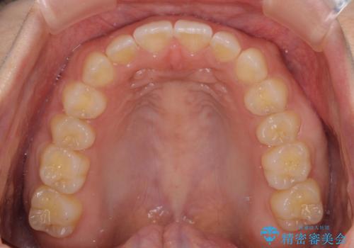 気になる隙間の再矯正 前歯をインビザライン・ライトで改善の治療中