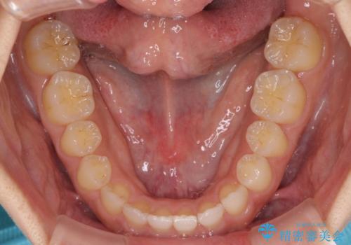 気になる隙間の再矯正 前歯をインビザライン・ライトで改善の治療中