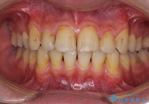 矯正治療後のセラミッククラウンの治療前