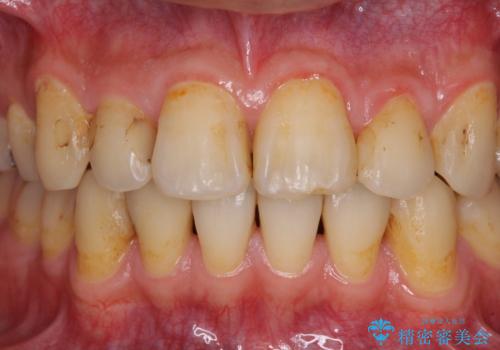 矯正治療後のセラミッククラウンの治療前