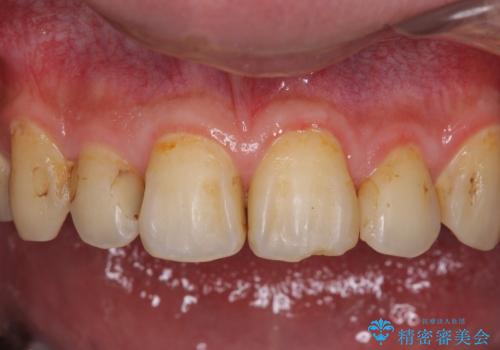 矯正治療後のセラミッククラウンの治療前