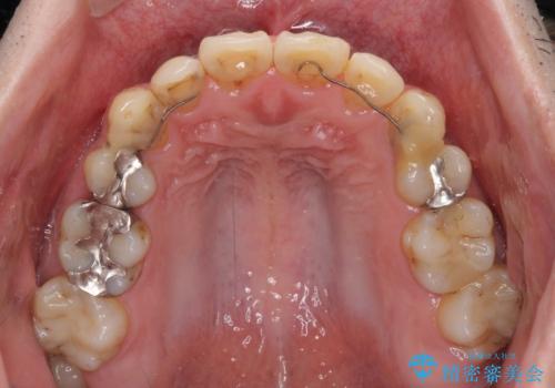 矯正治療後のセラミッククラウンの治療前