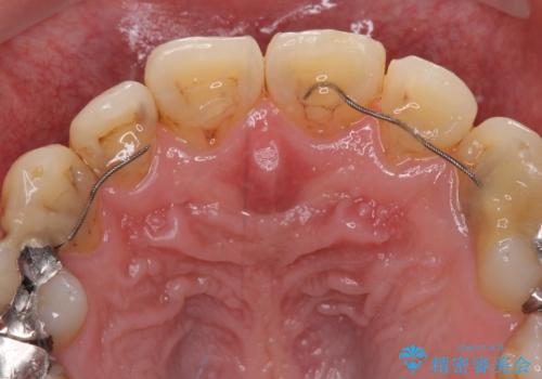 矯正治療後のセラミッククラウンの治療前