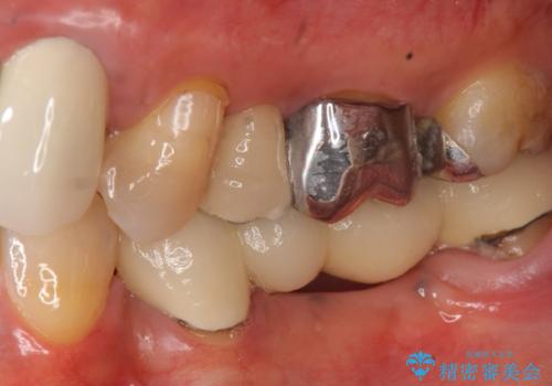 オールセラミッククラウン 不安定なブリッジの再補綴の治療前