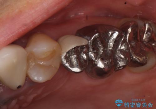 オールセラミッククラウン 不安定なブリッジの再補綴の治療前