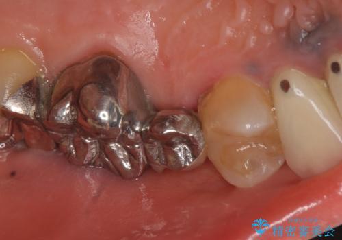 オールセラミッククラウン 不安定なブリッジの再補綴の治療前