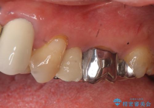 オールセラミッククラウン 不安定なブリッジの再補綴の治療前