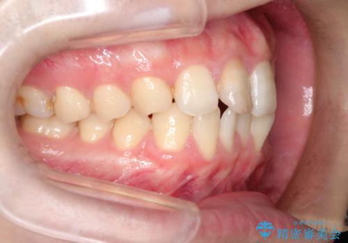 インビザラインとセラミック治療で整った歯並びへの治療前