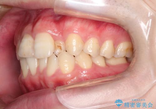 インビザラインとセラミック治療で整った歯並びへの治療前