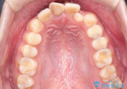 インビザラインとセラミック治療で整った歯並びへの治療前