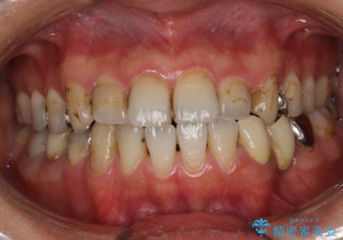 治療のスタート前に着色・ステインをPMTCできれいに除去の治療前