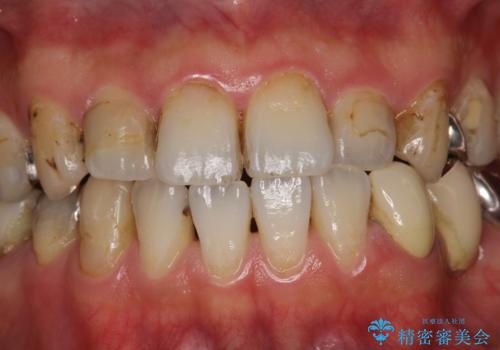 治療のスタート前に着色・ステインをPMTCできれいに除去の治療前