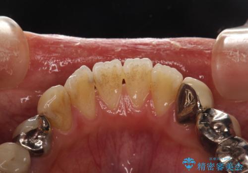 治療のスタート前に着色・ステインをPMTCできれいに除去の治療前