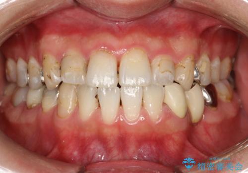 治療のスタート前に着色・ステインをPMTCできれいに除去の治療後