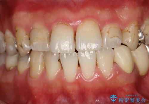 治療のスタート前に着色・ステインをPMTCできれいに除去の治療後